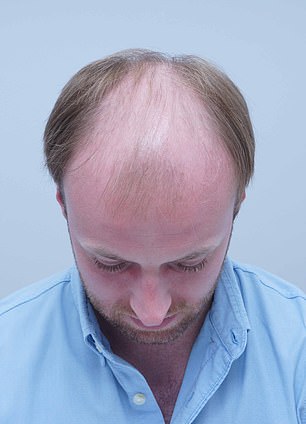 Alex Aitken's Hair Loss Journey: From Self-Doubt to Shared Understanding