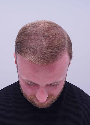 Alex Aitken's Hair Loss Journey: From Self-Doubt to Shared Understanding