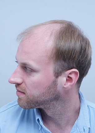 Alex Aitken's Hair Loss Journey: From Self-Doubt to Shared Understanding