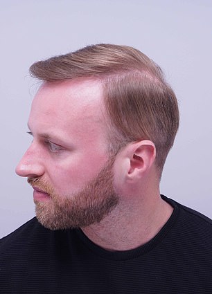 Alex Aitken's Hair Loss Journey: From Self-Doubt to Shared Understanding