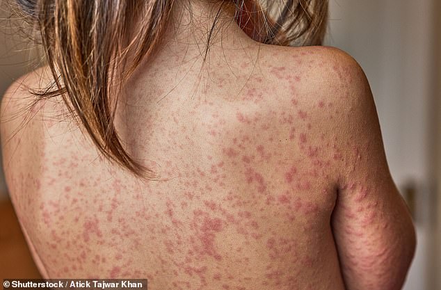Measles Outbreak Sparks Calls for School Exclusion as Cases Surge and Vaccination Rates Drop