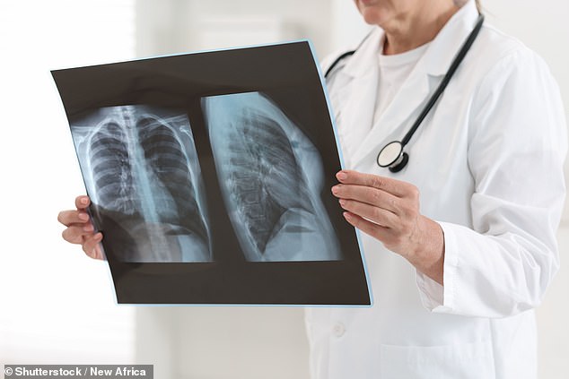 Study Reveals Severe Viral Infections May Reprogram Lungs, Elevating Lung Cancer Risk Years Later