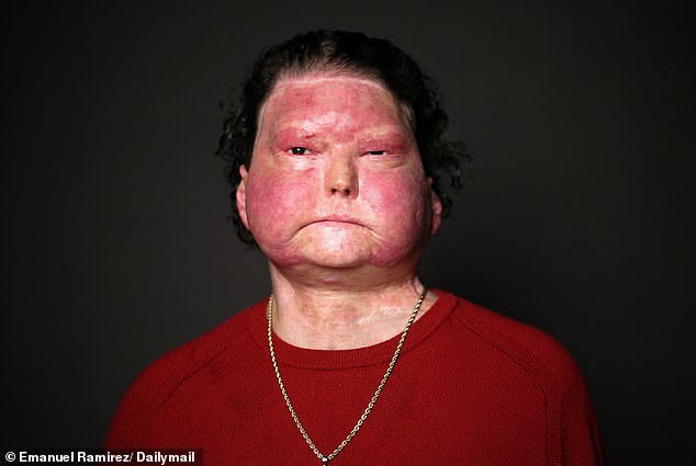 Joseph DiMeo's Miraculous Survival After Critical Burn Injury from Sleep-Deprived Driving Accident