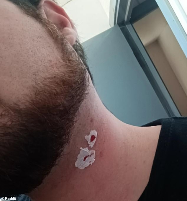 The Hidden Dangers of Single-Blade Shavers: Unexpected Skin Injuries and Risks