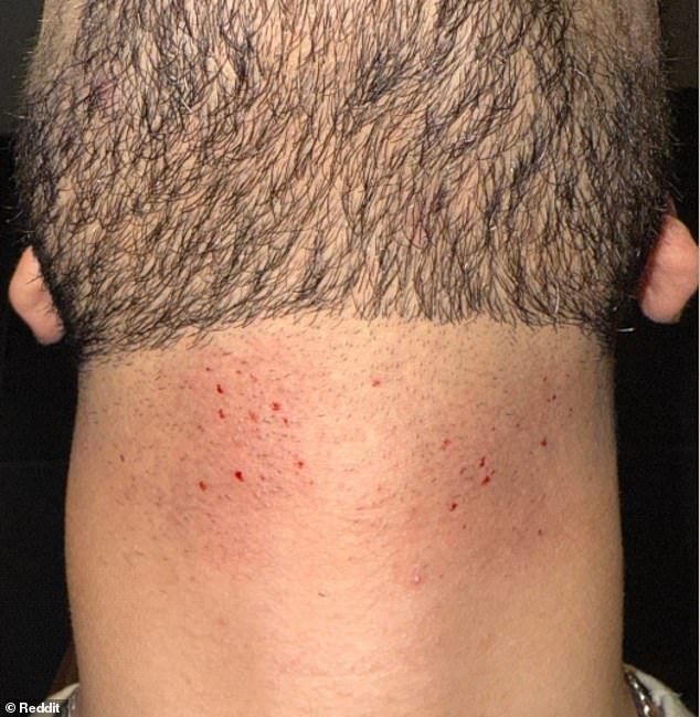 The Hidden Dangers of Single-Blade Shavers: Unexpected Skin Injuries and Risks