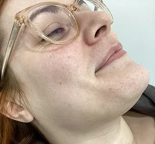 The Daily Struggle of Hirsutism: A Young Woman's Journey with PCOS