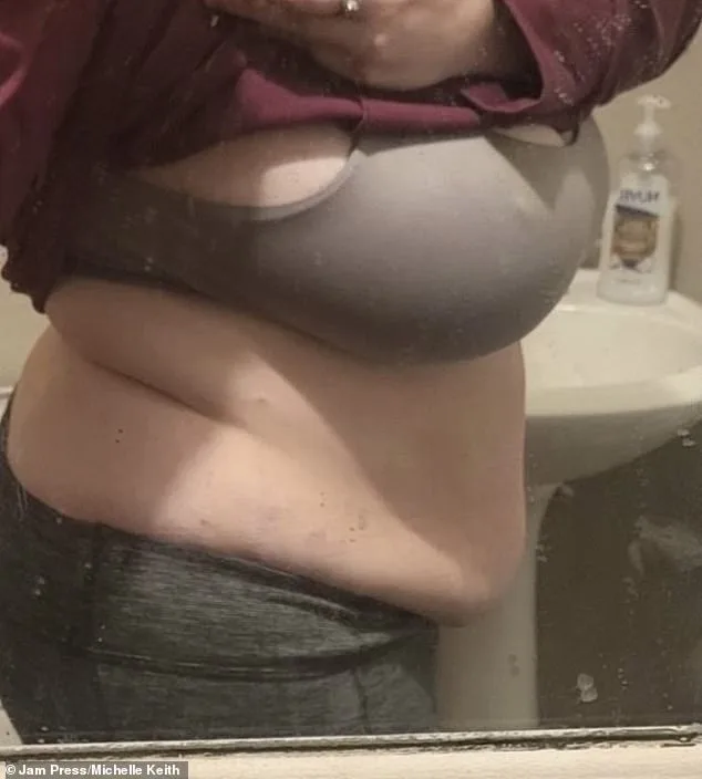 Michelle Keith's Fight Against Lipoedema: A Mother's Struggle with Unrelenting Fat and Pain