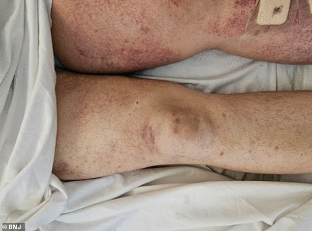 Scurvy's Resurgence: UK Health Crisis Linked to GLP-1 Weight Loss Injections