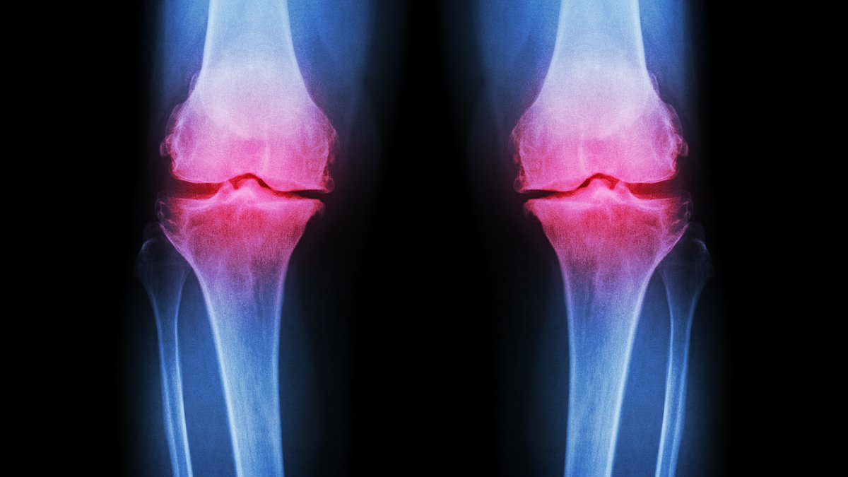 A Rising Crisis: Young Adults Face Bone Injuries and Early Osteoarthritis Due to High-Intensity Workouts and Extreme Diets, Warn Experts