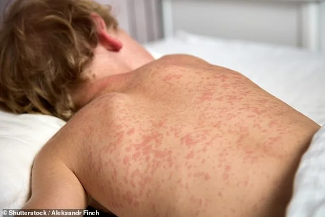 Philadelphia Airport Measles Exposure: Low Risk, but Unvaccinated Advised to Act