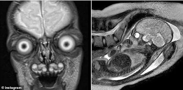 Unsettling Fetal MRI Images Reignite Debate on Safety and Necessity in Pregnancy