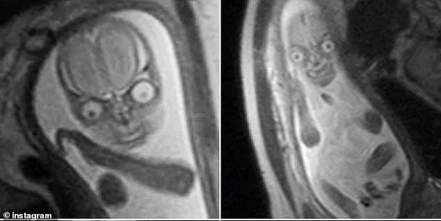 Unsettling Fetal MRI Images Reignite Debate on Safety and Necessity in Pregnancy