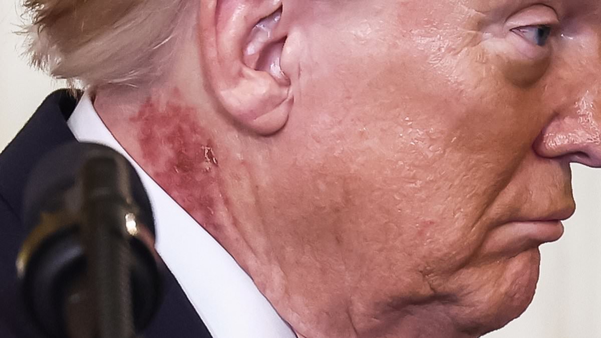 Trump's Red Rash Sparks Speculation Amid Medical Clarification