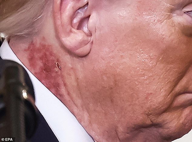 Trump's Red Rash Sparks Speculation Amid Medical Clarification