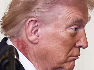 Trump's Red Rash Sparks Speculation Amid Medical Clarification