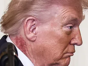Trump's Red Rash Sparks Speculation Amid Medical Clarification