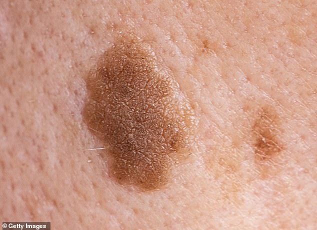 Trump's Red Rash Sparks Speculation Amid Medical Clarification