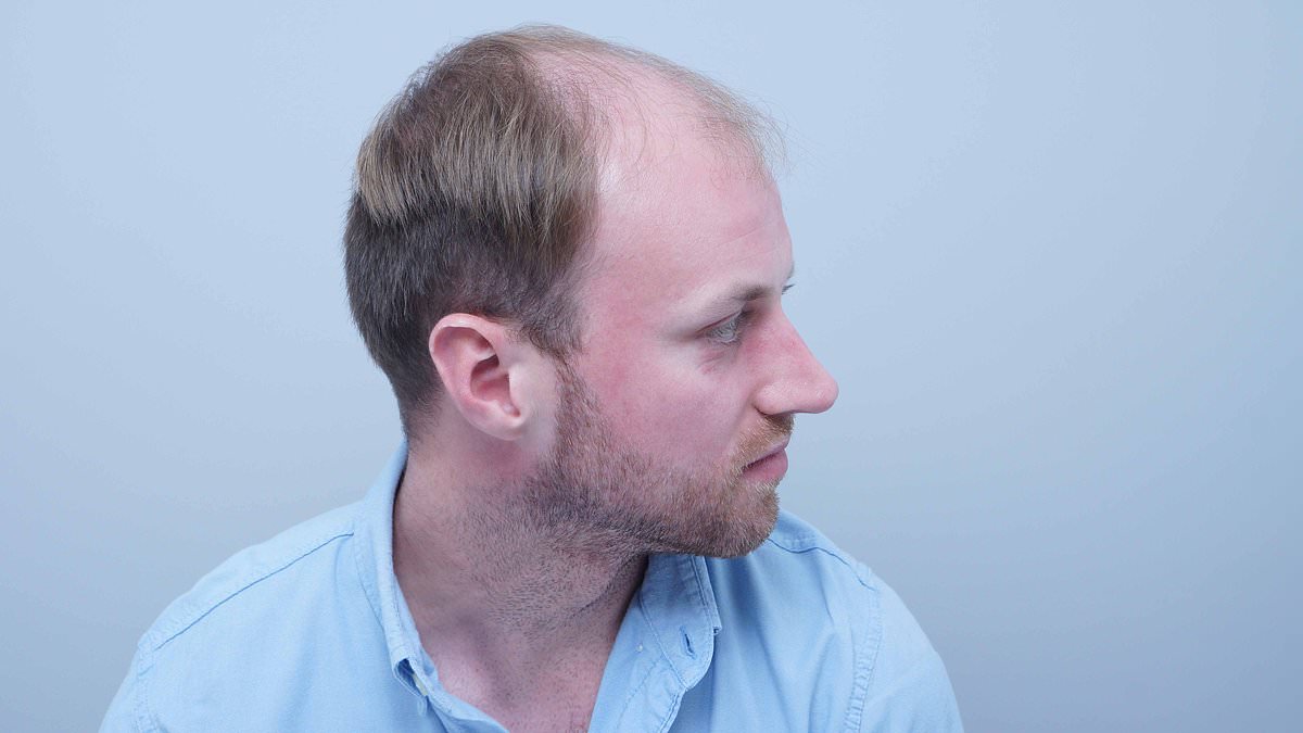 Alex Aitken's Hair Loss Journey: From Self-Doubt to Shared Understanding