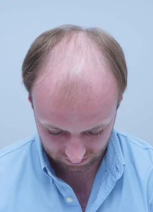 Alex Aitken's Hair Loss Journey: From Self-Doubt to Shared Understanding