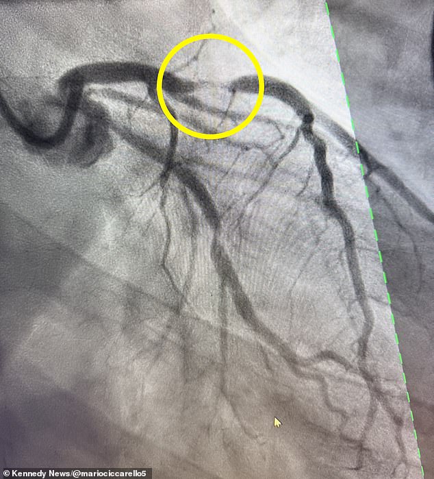 Fatal Denial: How a Fit Man Misread Heart Attack Symptoms