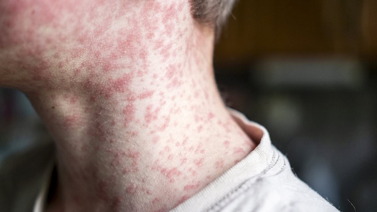 Measles' Terrifying Resurgence: Hidden Brain Damage Lurks Decades Later