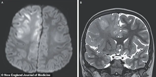 Measles' Terrifying Resurgence: Hidden Brain Damage Lurks Decades Later
