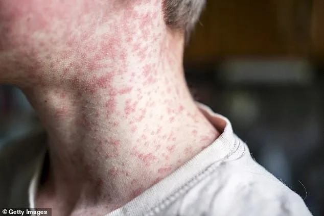 Measles' Terrifying Resurgence: Hidden Brain Damage Lurks Decades Later