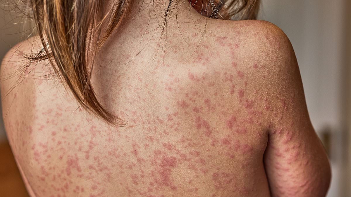 Measles Outbreak Sparks Calls for School Exclusion as Cases Surge and Vaccination Rates Drop
