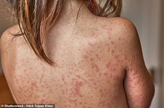 Measles Outbreak Sparks Calls for School Exclusion as Cases Surge and Vaccination Rates Drop