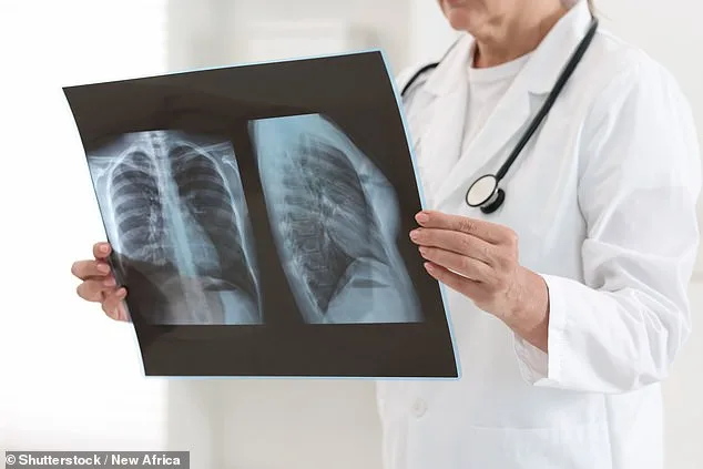 Study Reveals Severe Viral Infections May Reprogram Lungs, Elevating Lung Cancer Risk Years Later