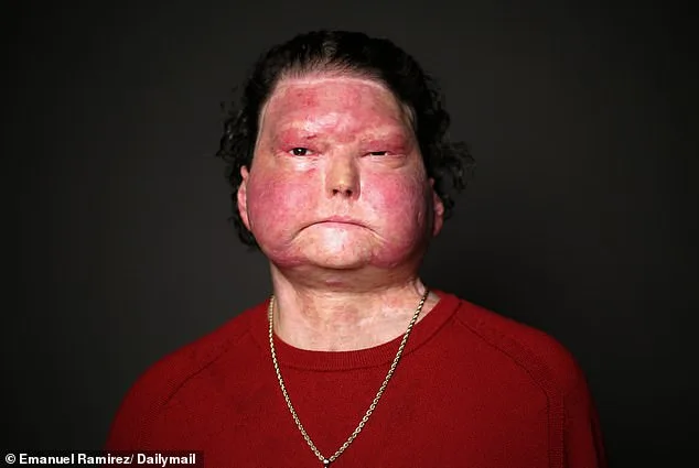 Joseph DiMeo's Miraculous Survival After Critical Burn Injury from Sleep-Deprived Driving Accident