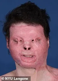 Joseph DiMeo's Miraculous Survival After Critical Burn Injury from Sleep-Deprived Driving Accident