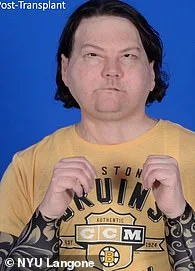 Joseph DiMeo's Miraculous Survival After Critical Burn Injury from Sleep-Deprived Driving Accident