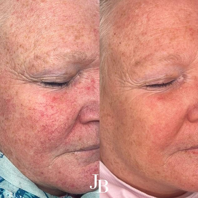 Celebrity-Backed BBL HEROic Laser Treatment Shown to Reduce Rosacea Symptoms by 90%—A Potential Game-Changer for Millions