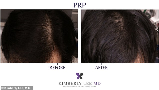 Breakthrough in Hair Loss Treatment: Affordable, Quick PRP Therapy Offers Hope for Baldness Fears