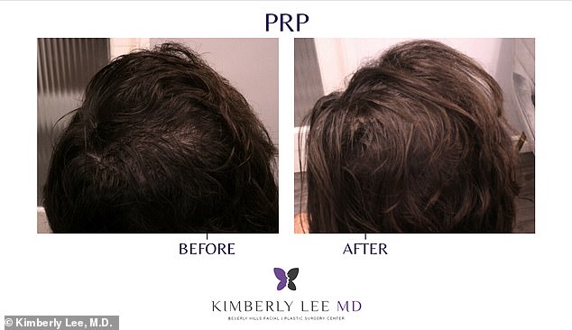 Breakthrough in Hair Loss Treatment: Affordable, Quick PRP Therapy Offers Hope for Baldness Fears