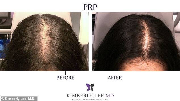 Breakthrough in Hair Loss Treatment: Affordable, Quick PRP Therapy Offers Hope for Baldness Fears