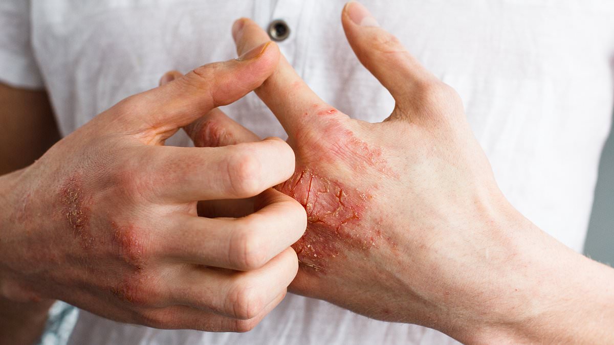 FDA Approves Groundbreaking Oral Medication for Psoriasis, Offering New Hope for Millions