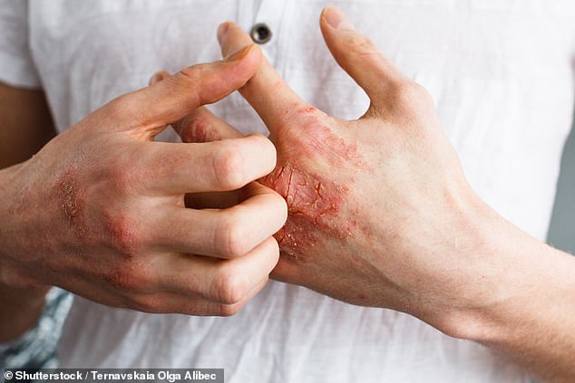 FDA Approves Groundbreaking Oral Medication for Psoriasis, Offering New Hope for Millions