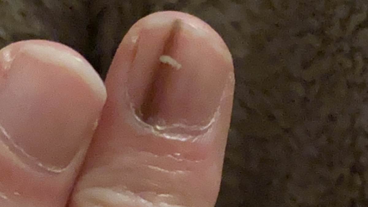 A Faint Brown Line Under the Nail: A Warning Sign of Deadly Cancer