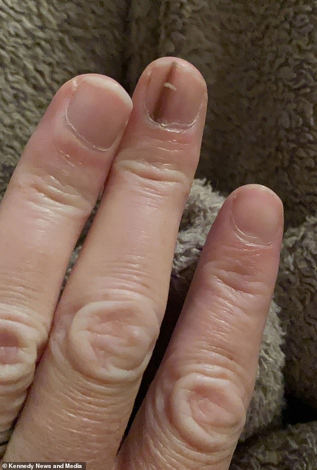 A Faint Brown Line Under the Nail: A Warning Sign of Deadly Cancer