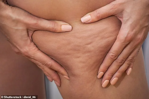 Breaking the Silence: Lipoedema, Celebrities, and the Struggle for Diagnosis