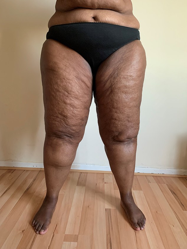 Breaking the Silence: Lipoedema, Celebrities, and the Struggle for Diagnosis