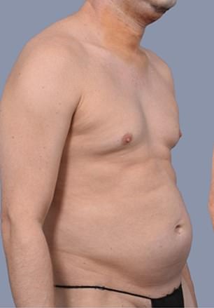 Frank Hoyle Spends $23k on Liposuction to Eliminate Stubborn Fat, Calls It a Miracle