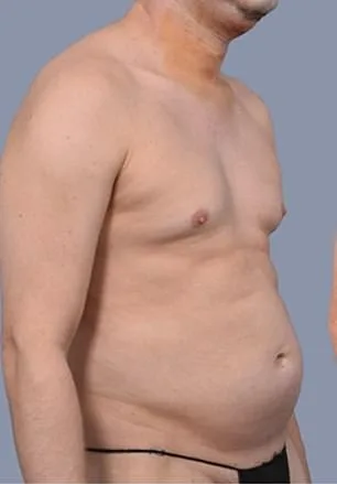 Frank Hoyle Spends $23k on Liposuction to Eliminate Stubborn Fat, Calls It a Miracle