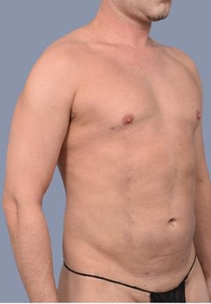 Frank Hoyle Spends $23k on Liposuction to Eliminate Stubborn Fat, Calls It a Miracle