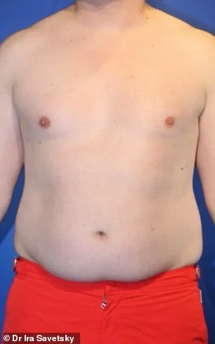 Frank Hoyle Spends $23k on Liposuction to Eliminate Stubborn Fat, Calls It a Miracle