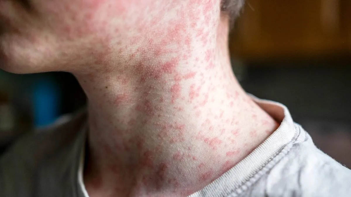 Measles Exposure Alert at Chicago O'Hare Airport: Thousands of Travelers May Have Been Exposed, Officials Urge Unvaccinated to Monitor Symptoms