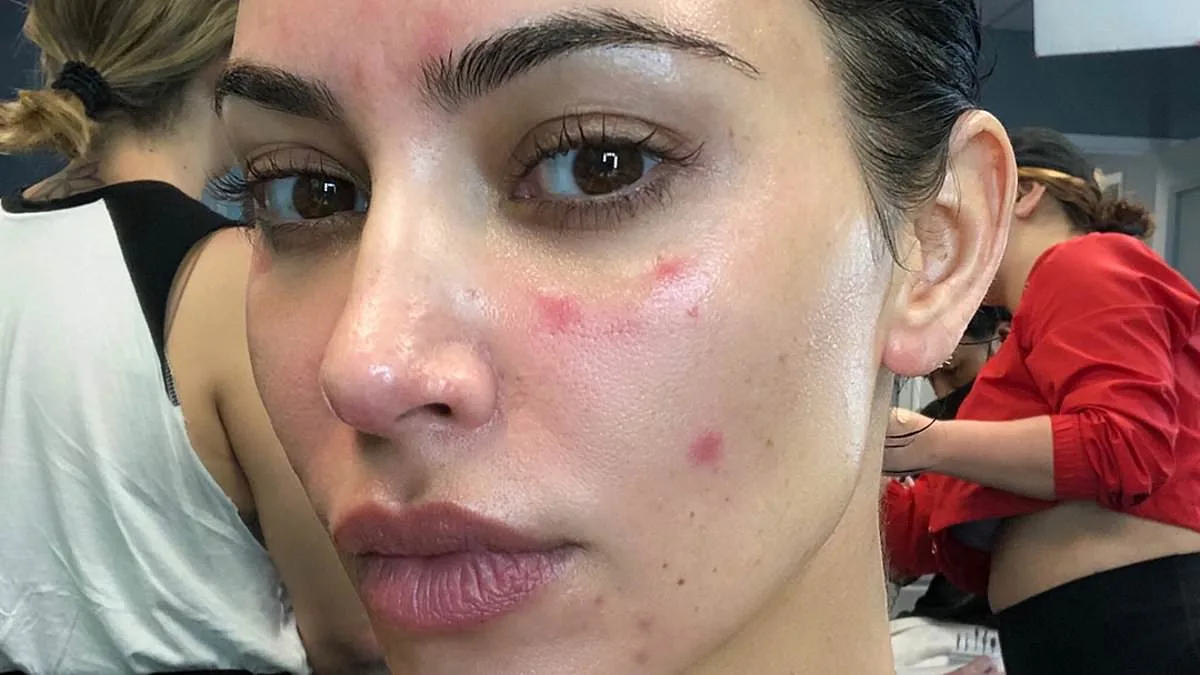 The Hidden Toll of Psoriasis: As Cases Soar, Stigma Persists in the UK