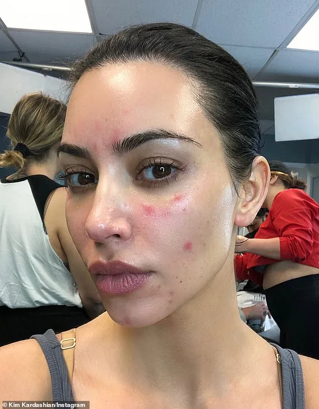 The Hidden Toll of Psoriasis: As Cases Soar, Stigma Persists in the UK